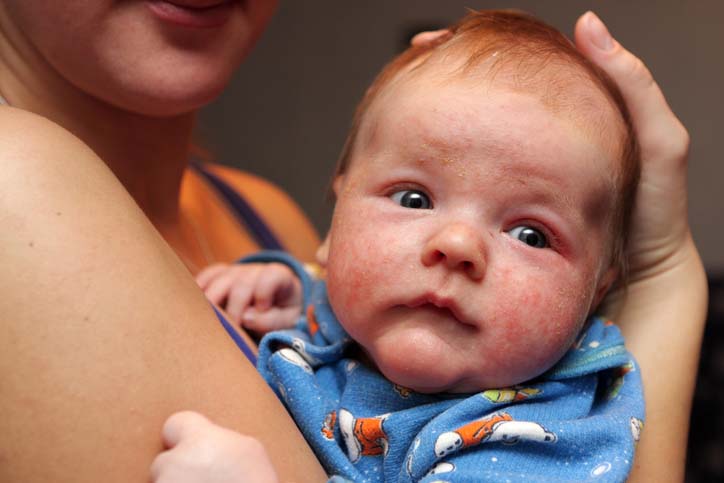 9 Doencas Comuns Entre As Criancas Durante A Primavera Bebe Com Br