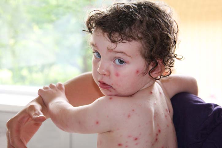9 Doencas Comuns Entre As Criancas Durante A Primavera Bebe Com Br 9 Doencas Comuns Entre As Criancas Durante A Primavera Bebe Com Br