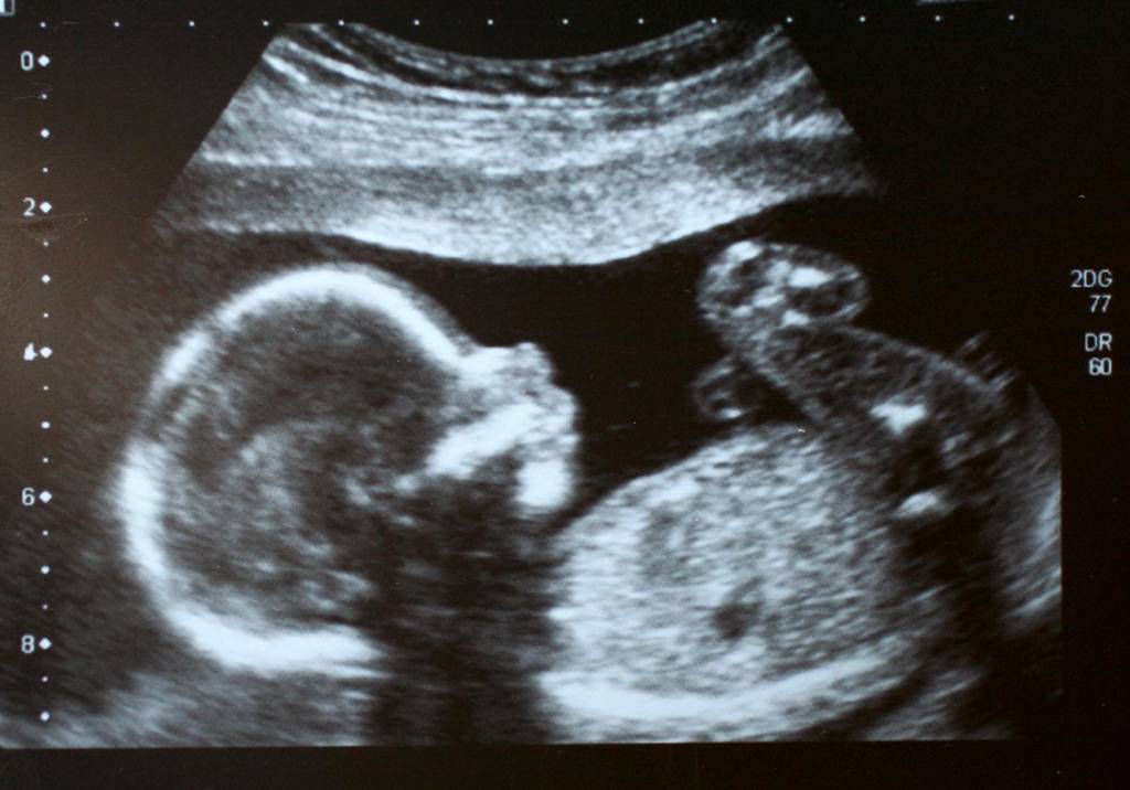 Translucência nucal: o que é e quais valores são considerados normais