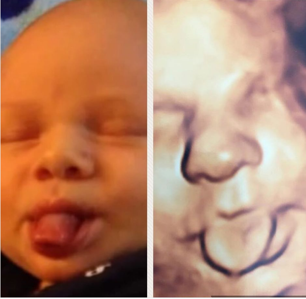 Médico compara posições de bebês antes e após o nascimento