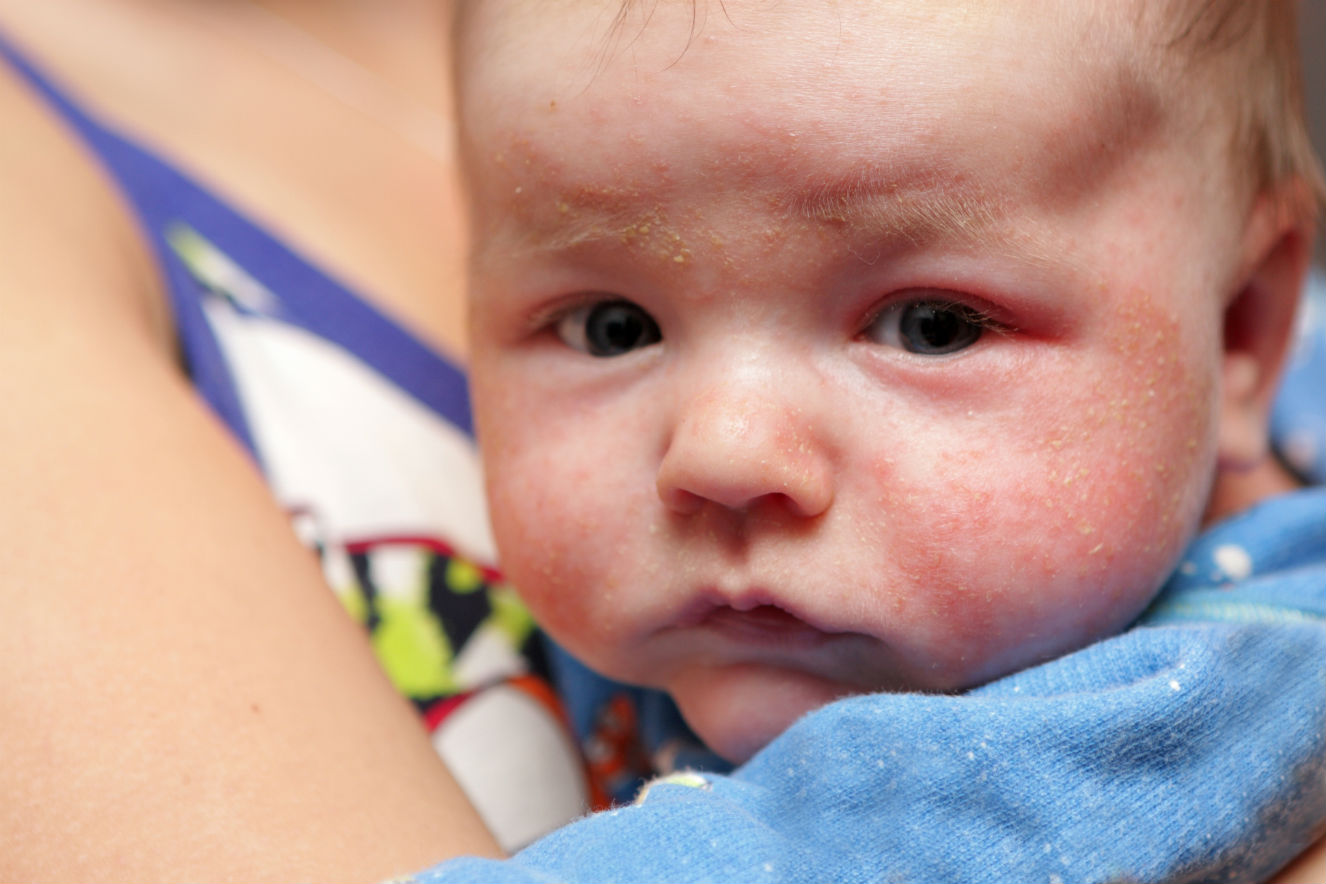 Dermatite atópica em crianças: Conheça os sintomas, diagnóstico e soluções