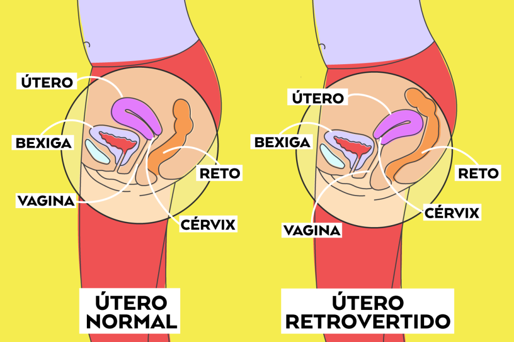 Útero normal e retrovertido