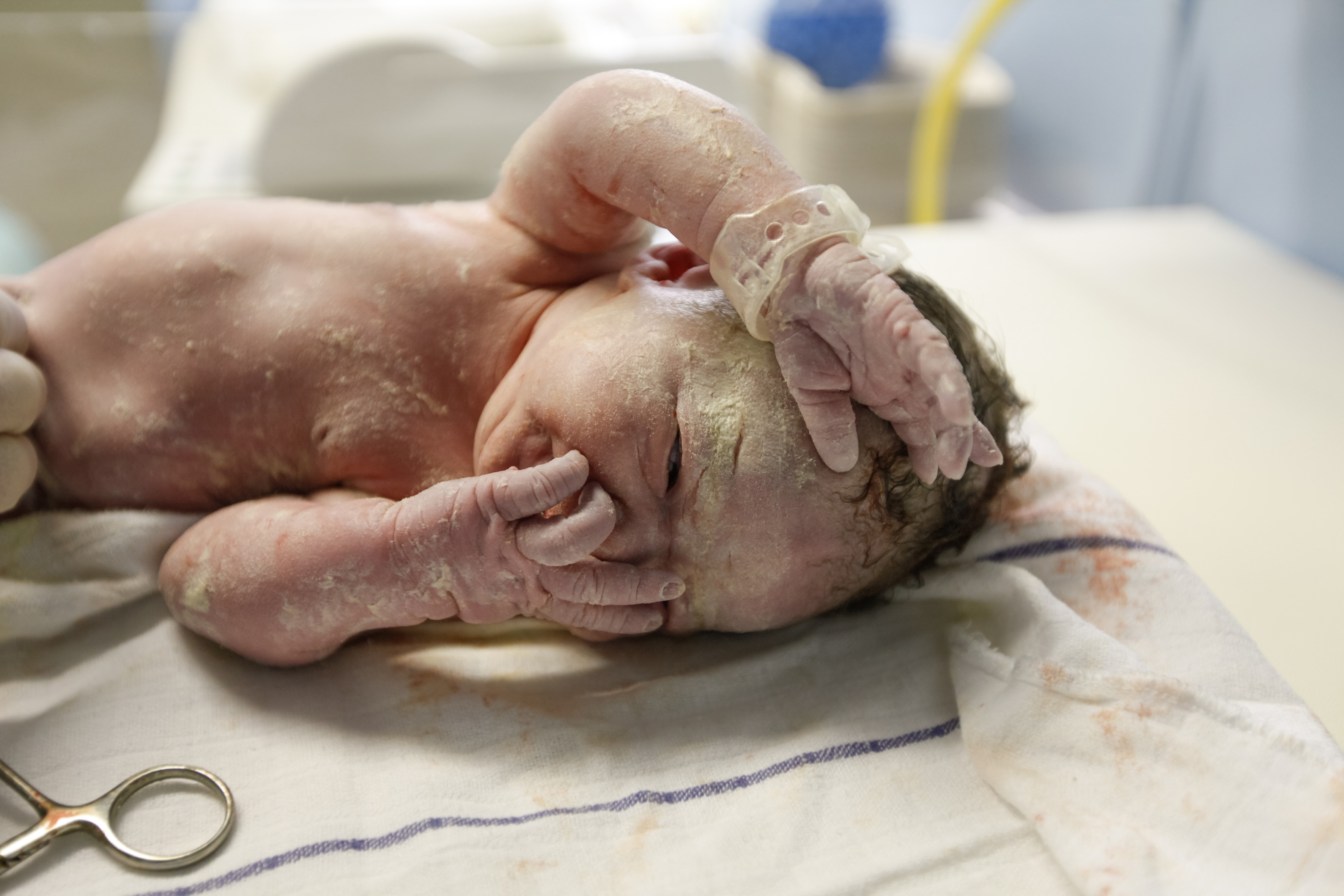 Recém-nascido coberto de vérnix deitado sobre tecido branco. Está com uma mãozinha em cima da boca/nariz e outra na testa