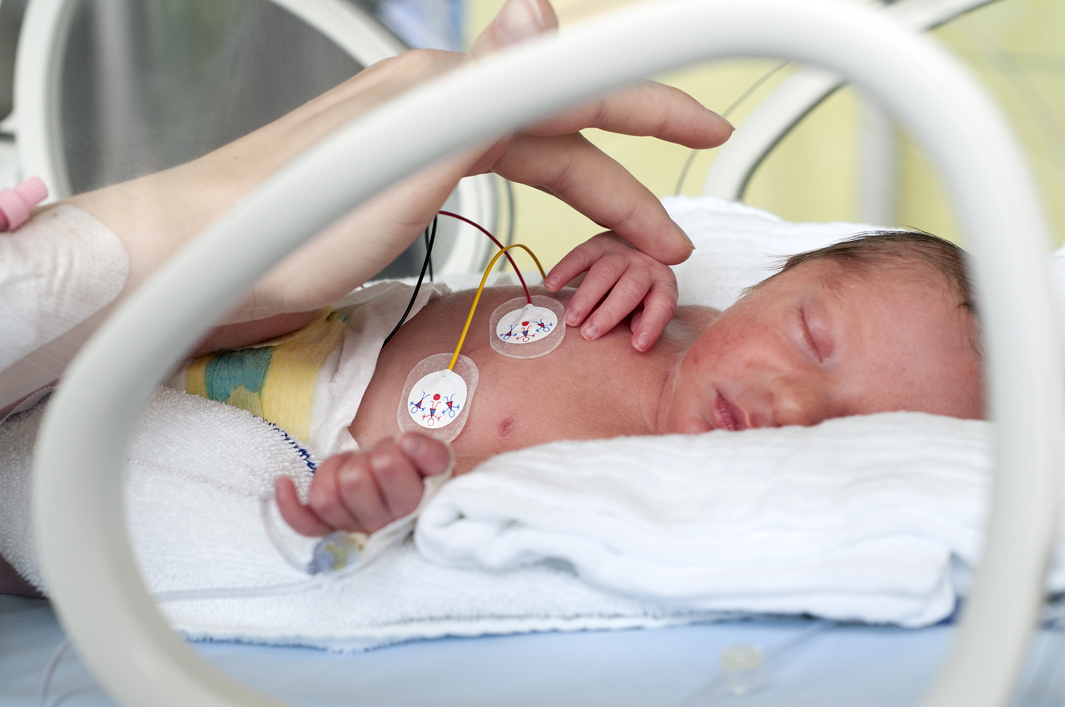 Importância do Método Canguru para a queda de nascimentos prematuros