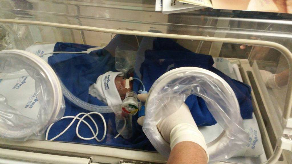 Menor bebê prematura do Brasil, que nasceu com 340 gramas