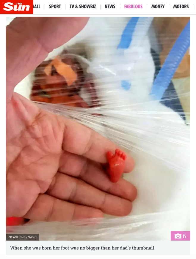 Bebê indiana que nasceu prematura, com menos de 400 gramas