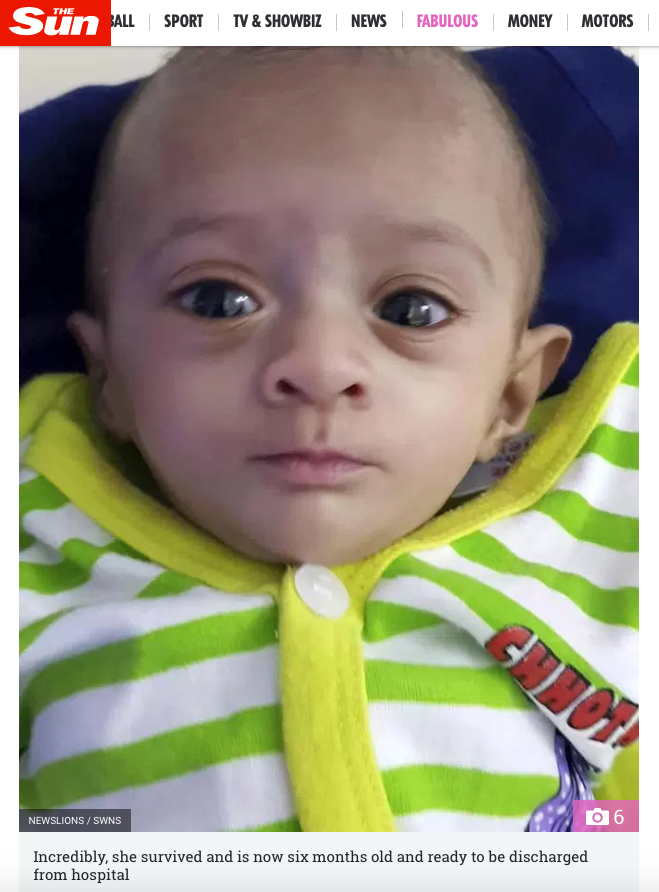 Bebê indiana que nasceu prematura, com menos de 400 gramas