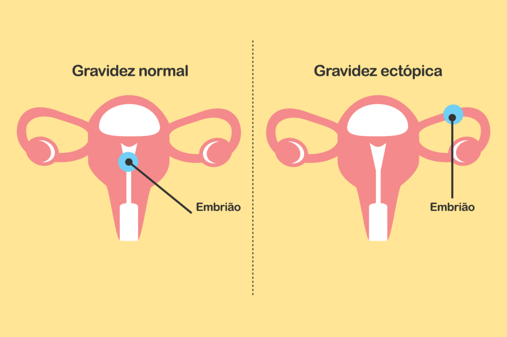 gravidez ectópica