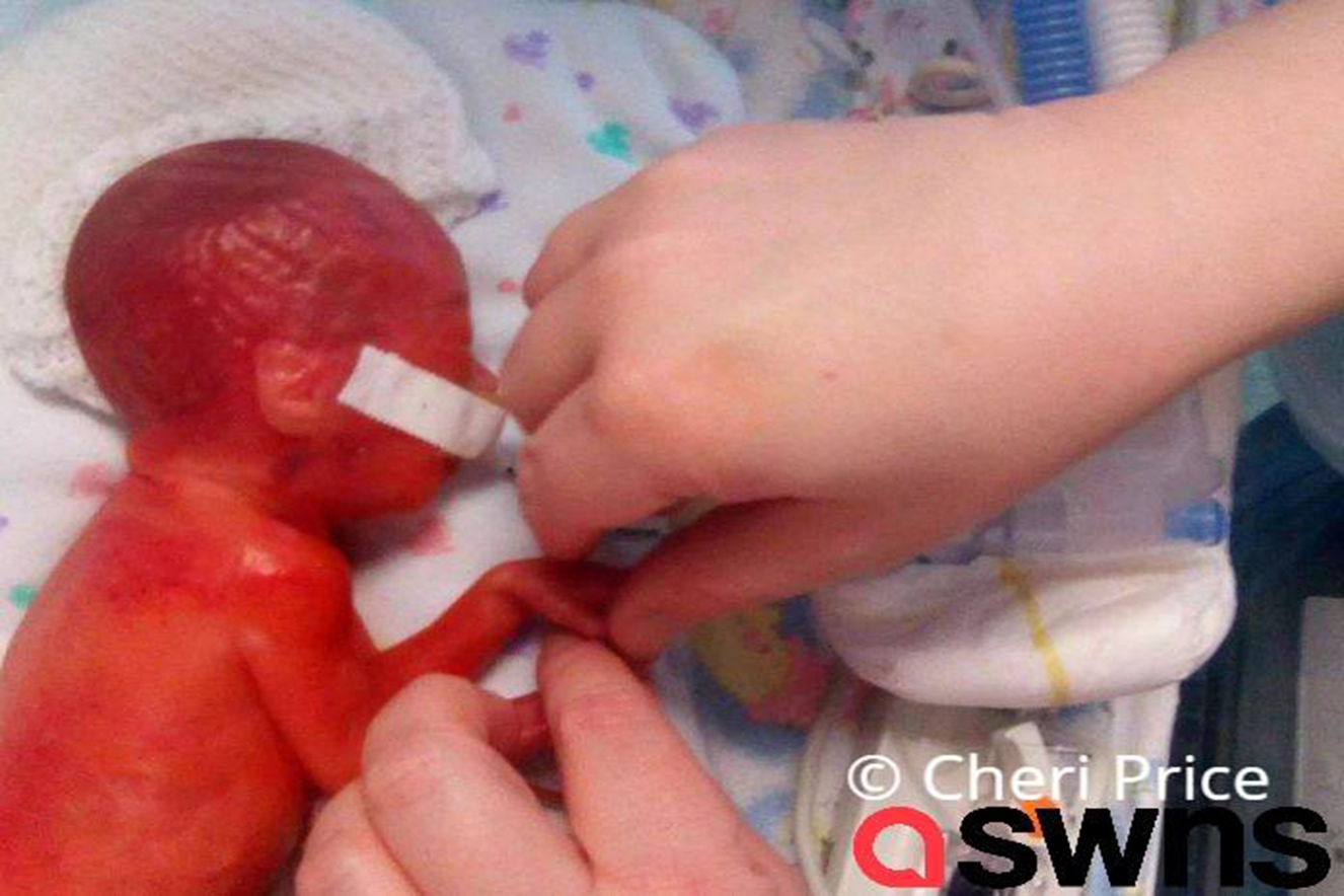 Bebê nasce tão prematura que é possível enxergar seu cérebro