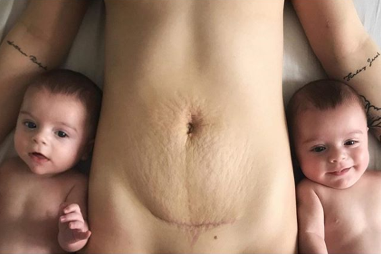 Mãe de gêmeos faz apelo sobre o corpo no pós-parto