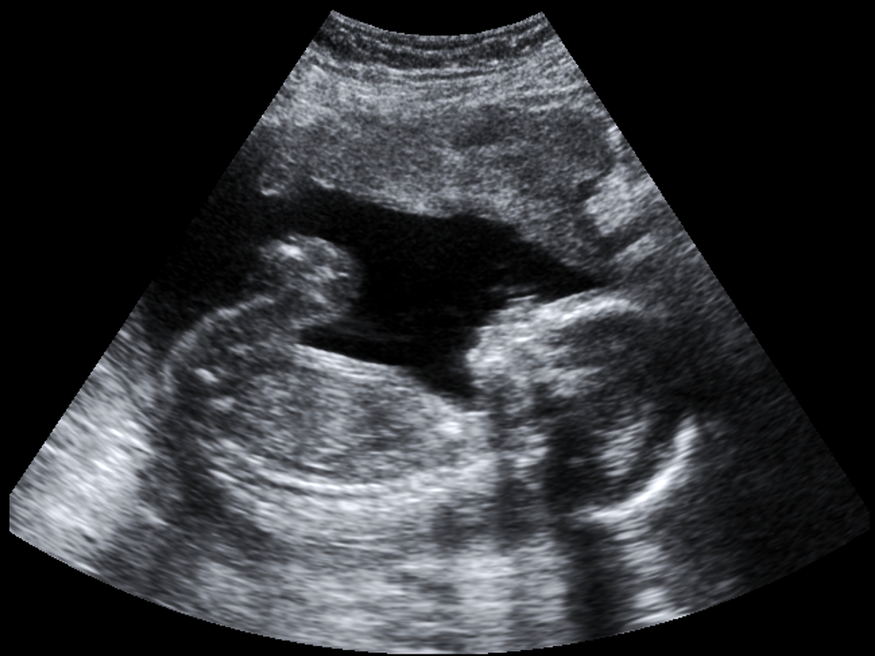 Ultrassom morfológico: Importância, detalhes e análises na gravidez