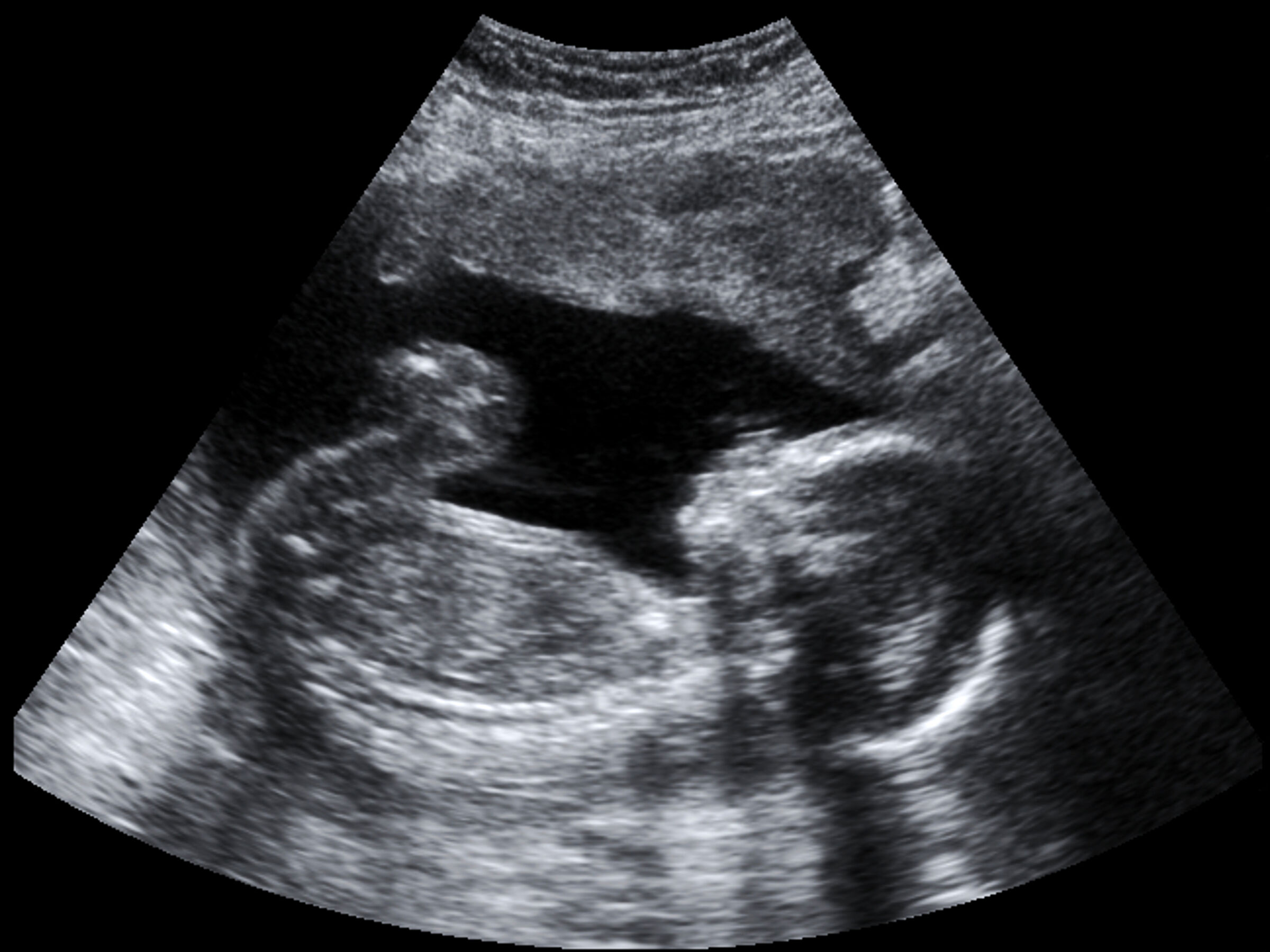 Exame de ultrassom na gravidez