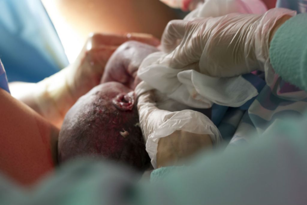 Bebê de pele branca sendo retirado do útero por cesariana. Na foto, é possível ver apenas a cabeça do bebê e as mãos dos profissionais, além de alguns tecidos.