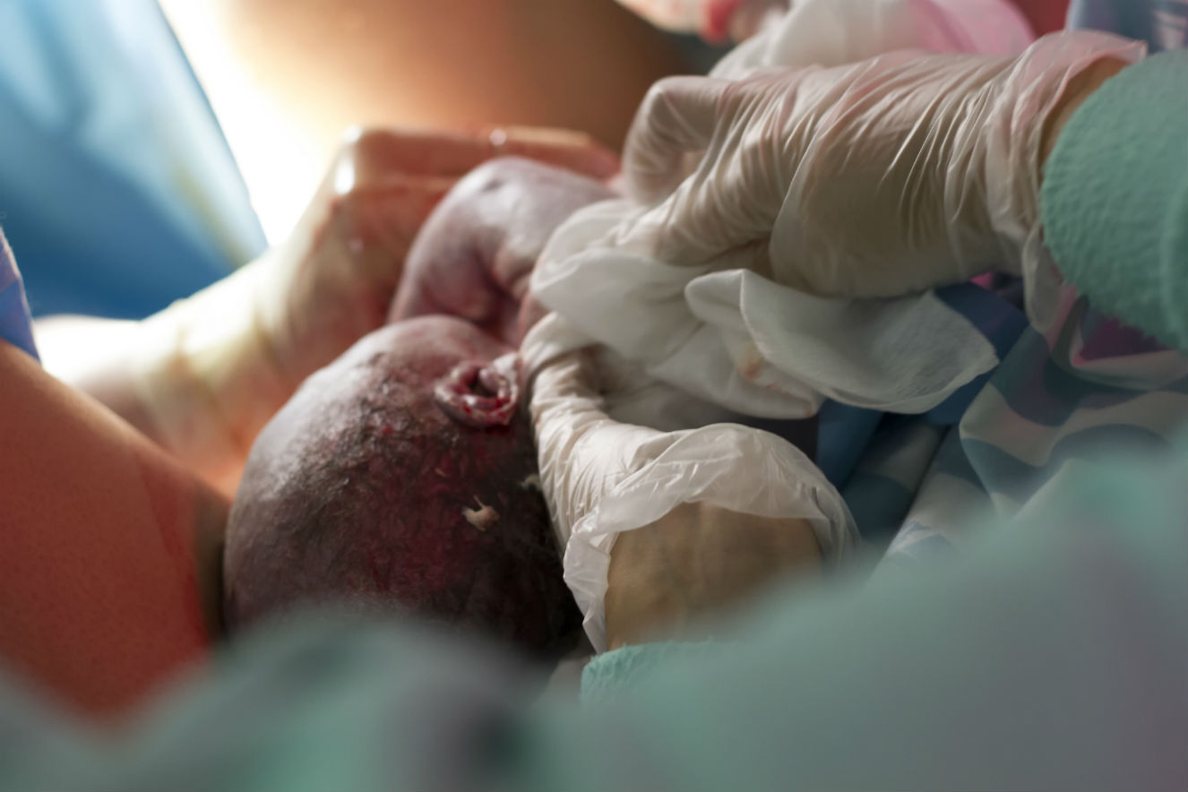 Bebê de pele branca sendo retirado do útero por cesariana. Na foto, é possível ver apenas a cabeça do bebê e as mãos dos profissionais, além de alguns tecidos.