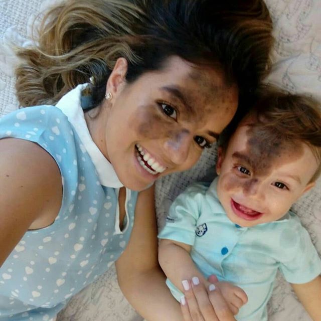 Para ficar igual ao filho que nasceu com mancha, mãe pinta o próprio rosto