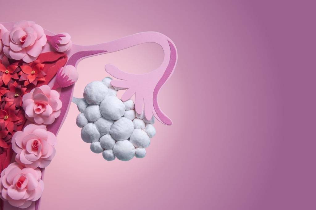 Síndrome dos ovários policísticos: como ela afeta a gravidez e quando ficar alerta