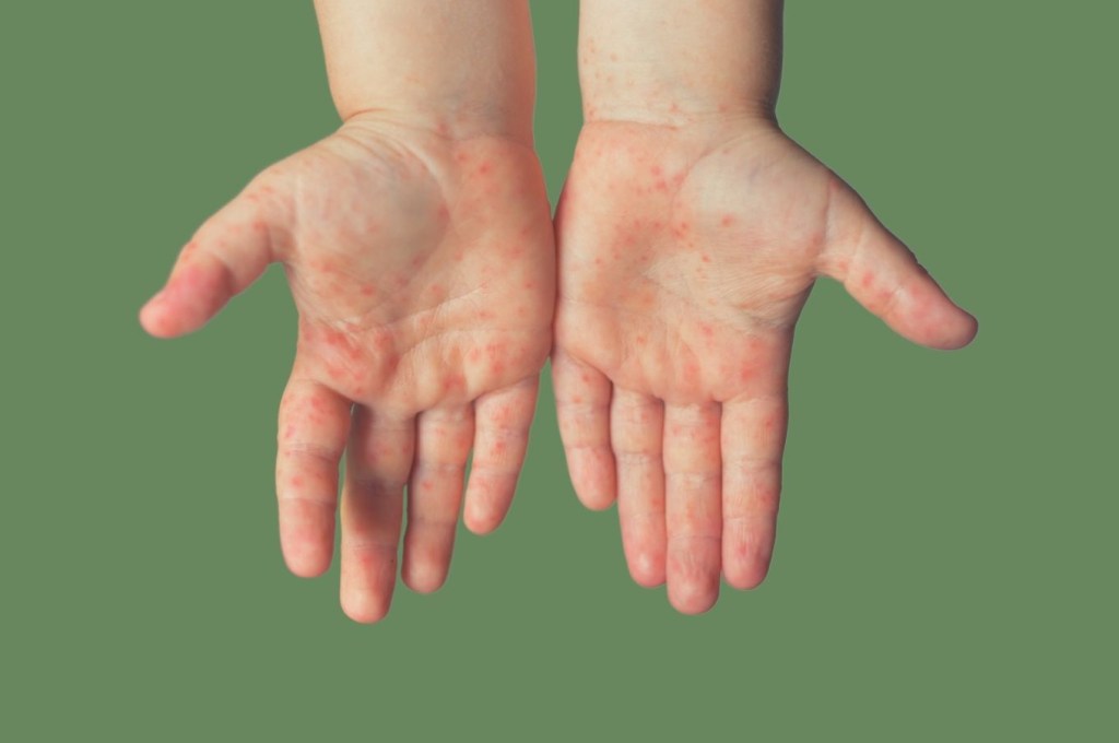Mãos de criança com manchas avermelhadas