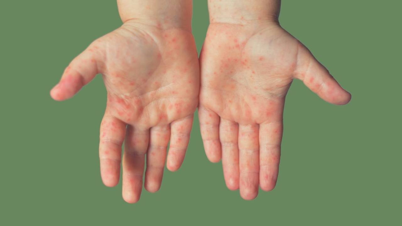 Mãos de criança com manchas avermelhadas