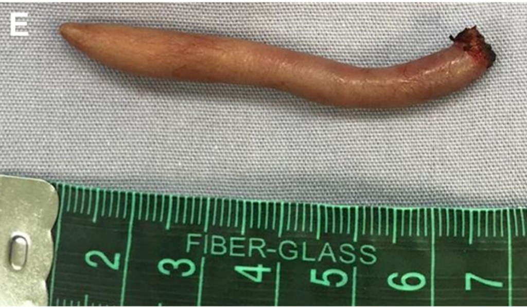 Há quatro imagens que mostram a retirada cirúrgica da cauda. A última mostra apenas a cauda, com comprimento aproximado de 6 cm.