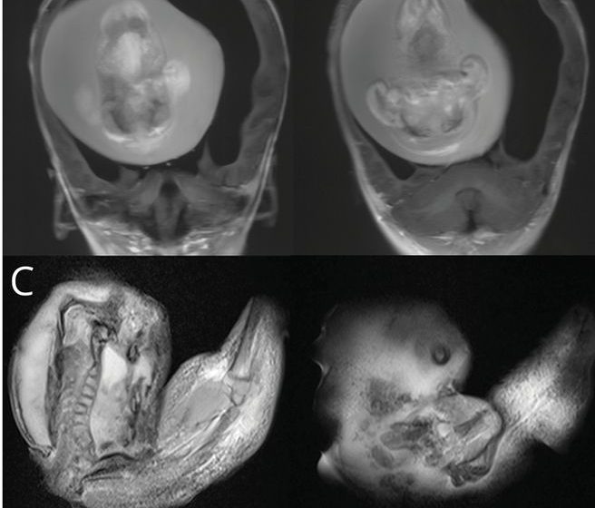 4 imagens de uma tomografia cranial de bebê. É possível observar nas duas imagens de baixo a formação incompleta de um feto, com coluna vertebral.