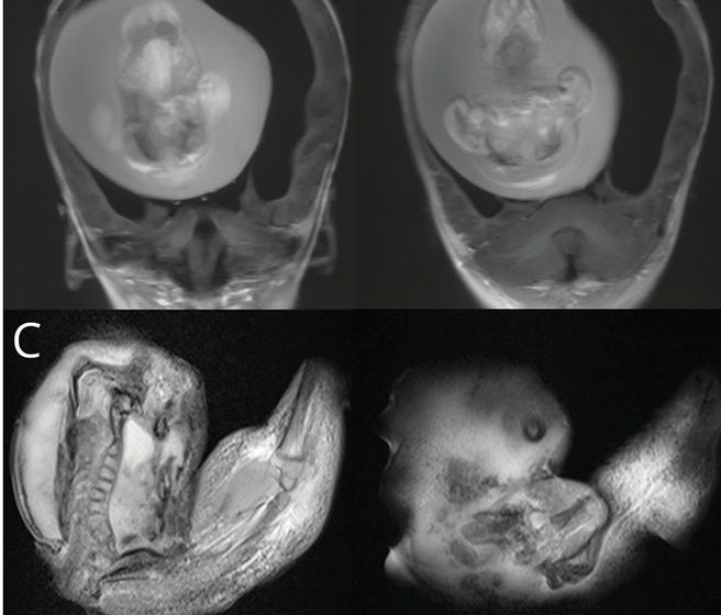 Nas imagens de tomografia, é possível observar a coluna vertebral e outros ossos da massa fetiforme, bem como o espaço ocupado na caixa cranial