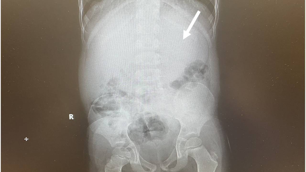 raio X de criança com massa de chiclete no estômago