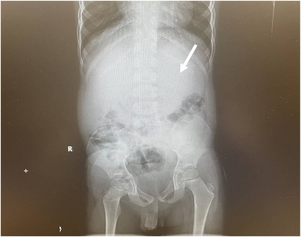 Criança de 5 anos engole 40 chicletes e passa por cirurgia de emergência