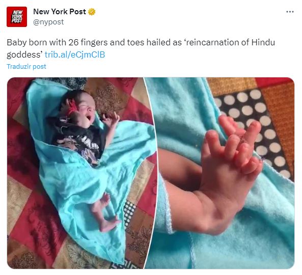 bebe nasce 26 dedos na india print de um tuíte mostrando duas imagens de uma bebê que nasceu com 7 dedos em cada mãe e seis em cada pé