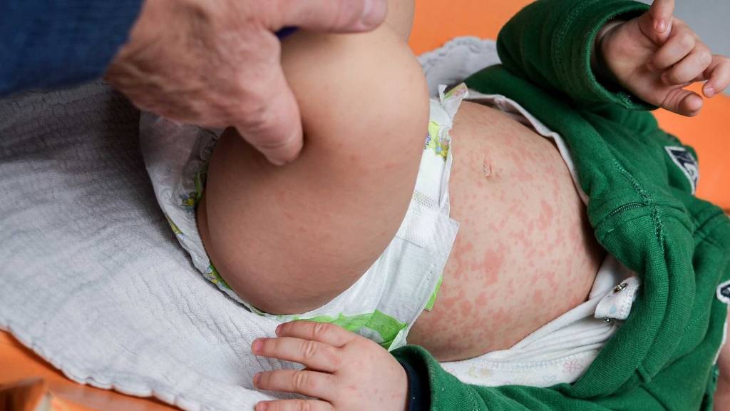 Roséola infantil: transmissão, sintomas comuns e formas de tratamento
